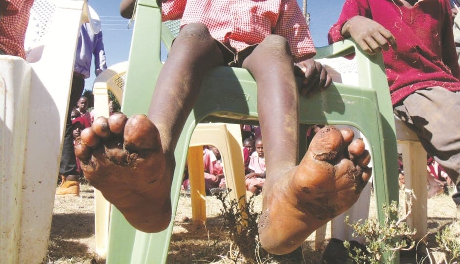 Jigger infestation in Butere schools a big concern