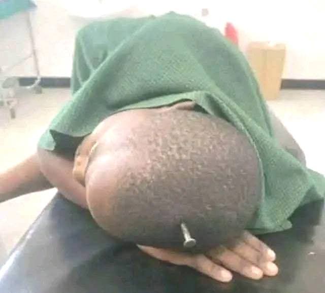 Grade 3 boy hospitalized after stepmother drives nails into his head over eggs