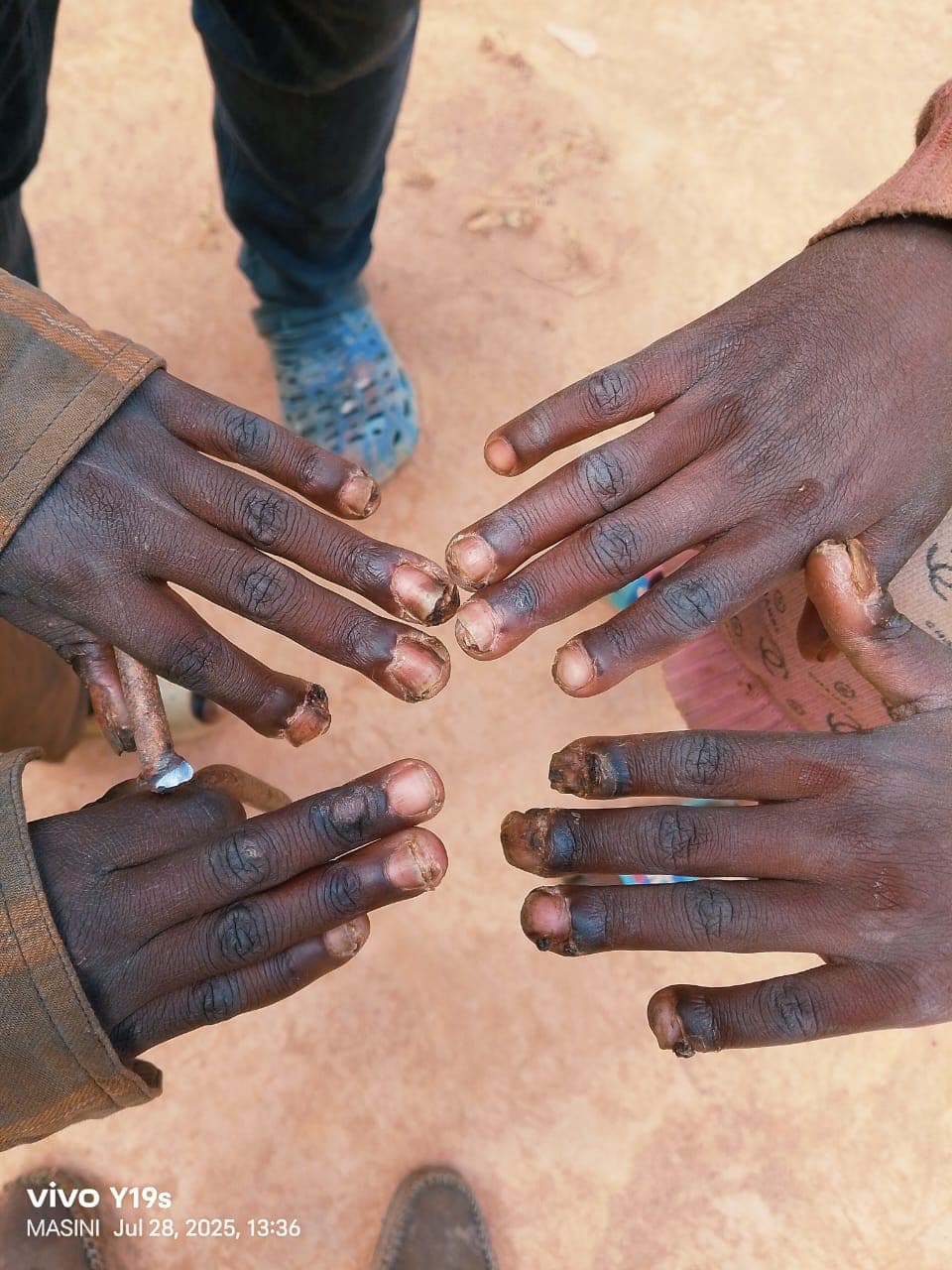 Makueni family calls for medical appeal after 3 children infested by jiggers