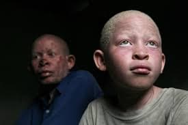 Hope for albino learners as NGO starts training school to accommodate them