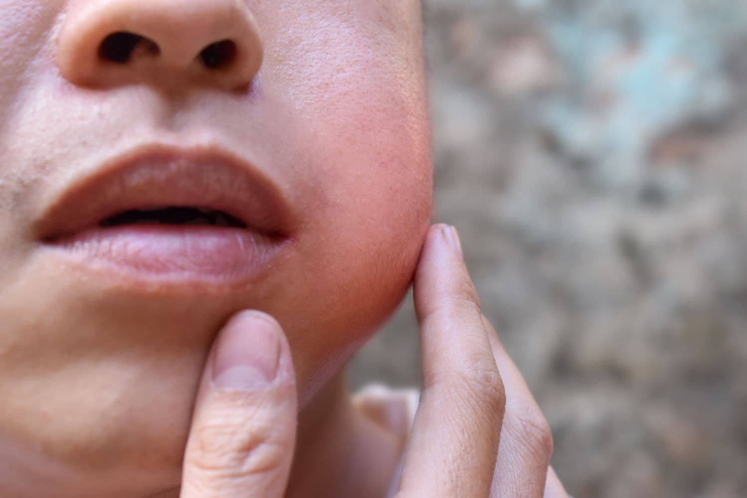 Suspected mumps cases reported in Nairobi schools, parents urged to stay alert