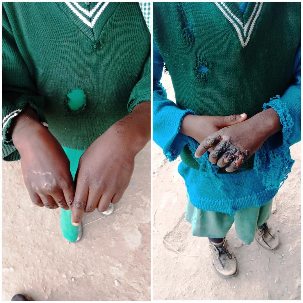 Mother burns daughters’ hands for eating sugar