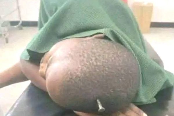 Grade 3 boy hospitalized after stepmother drives nails into his head over eggs
