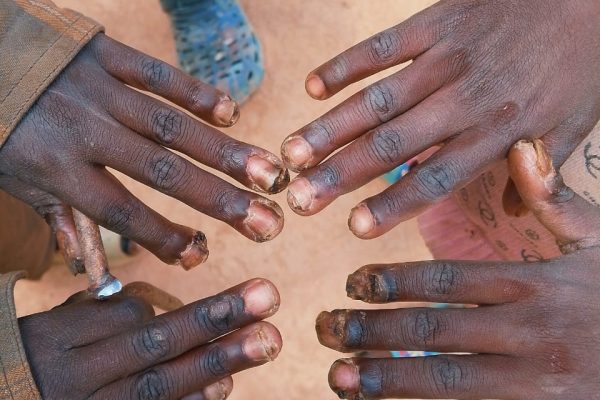 Makueni family calls for medical appeal after 3 children infested by jiggers