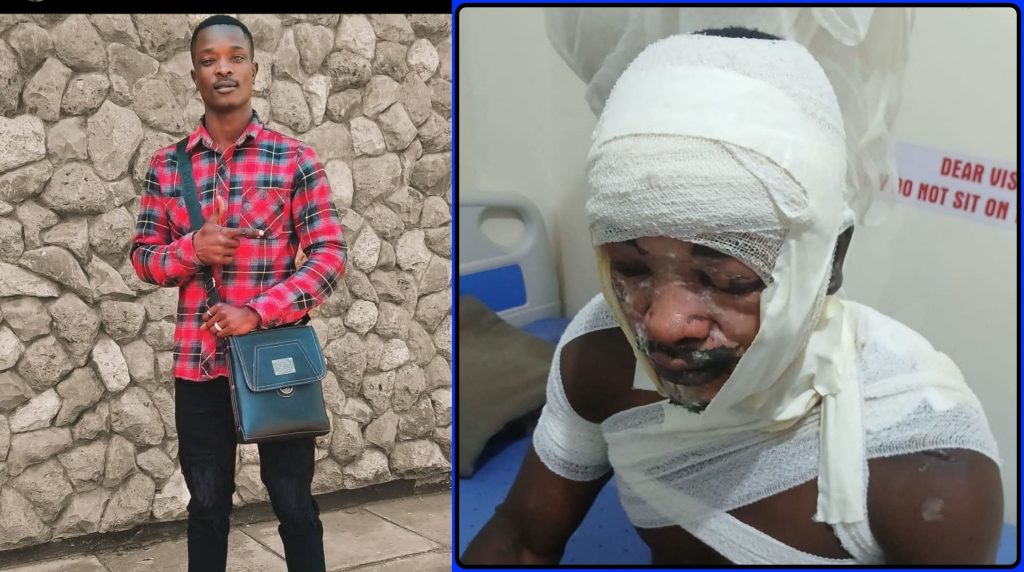 MMU student scalded by his girlfriend in Nairobi