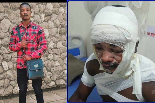 MMU student scalded by his girlfriend in Nairobi