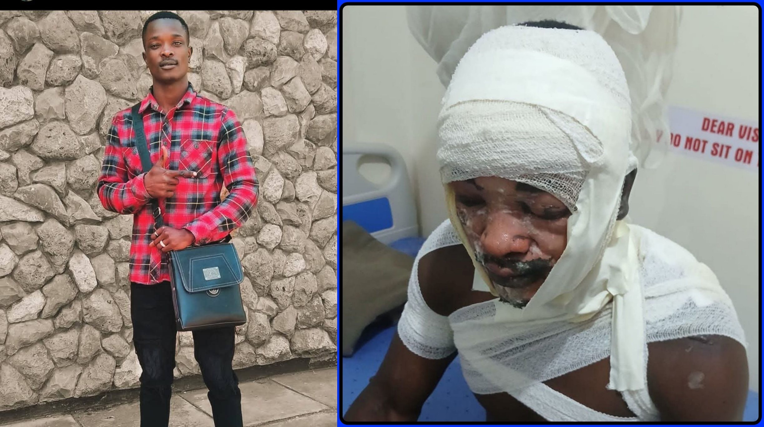 MMU student scalded by his girlfriend in Nairobi