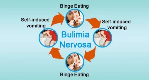 Bulimia Nervosa is a serious eating disorder in which a person repeatedly eats large amounts of food within a short period of time and then forces the food out of the body