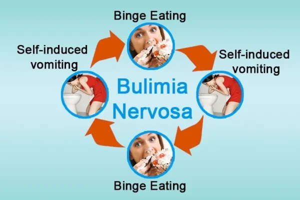Bulimia Nervosa is a serious eating disorder in which a person repeatedly eats large amounts of food within a short period of time and then forces the food out of the body