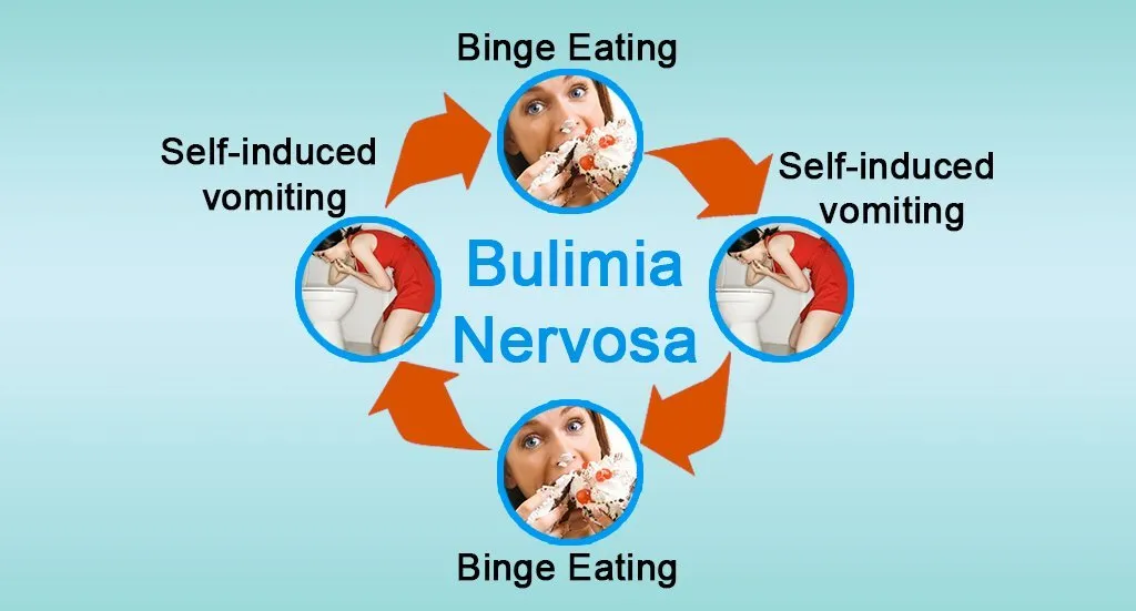 Bulimia Nervosa is a serious eating disorder in which a person repeatedly eats large amounts of food within a short period of time and then forces the food out of the body